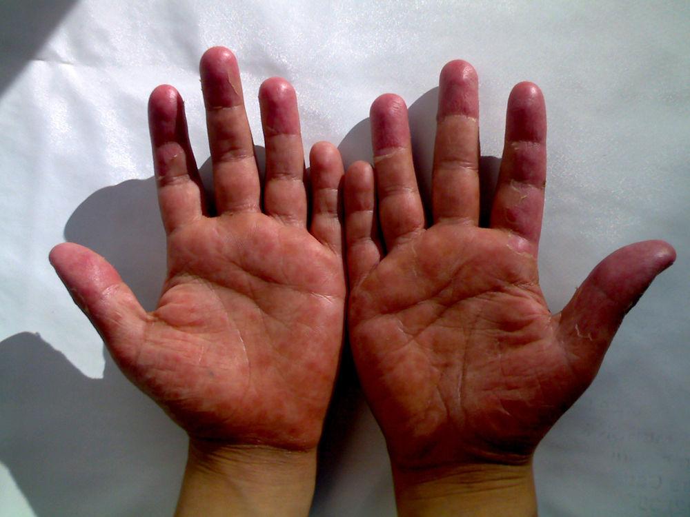 EBV-induced erythema multiforme: a case report | Allergologia et ...