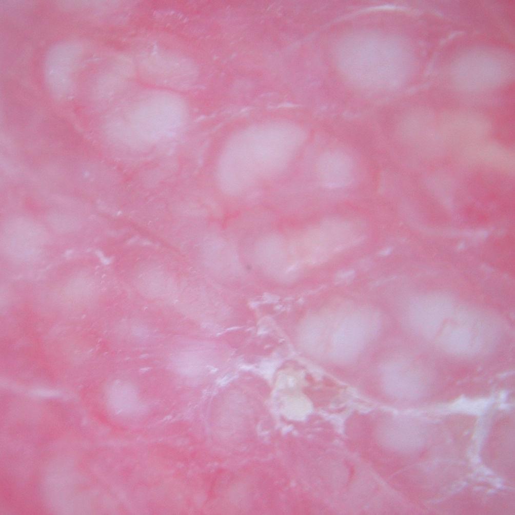 Dermoscopy of inflammatory breast cancer* | Anais Brasileiros de ...