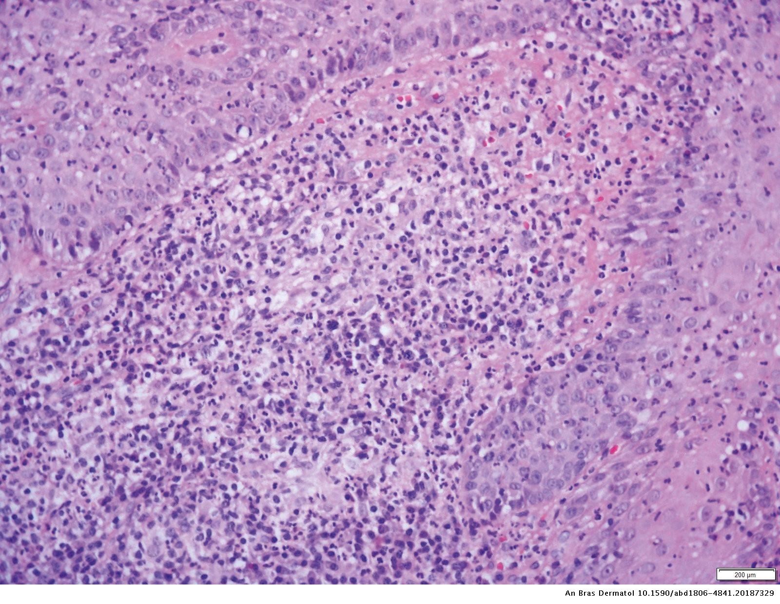 Pyoderma Gangrenosum Histology