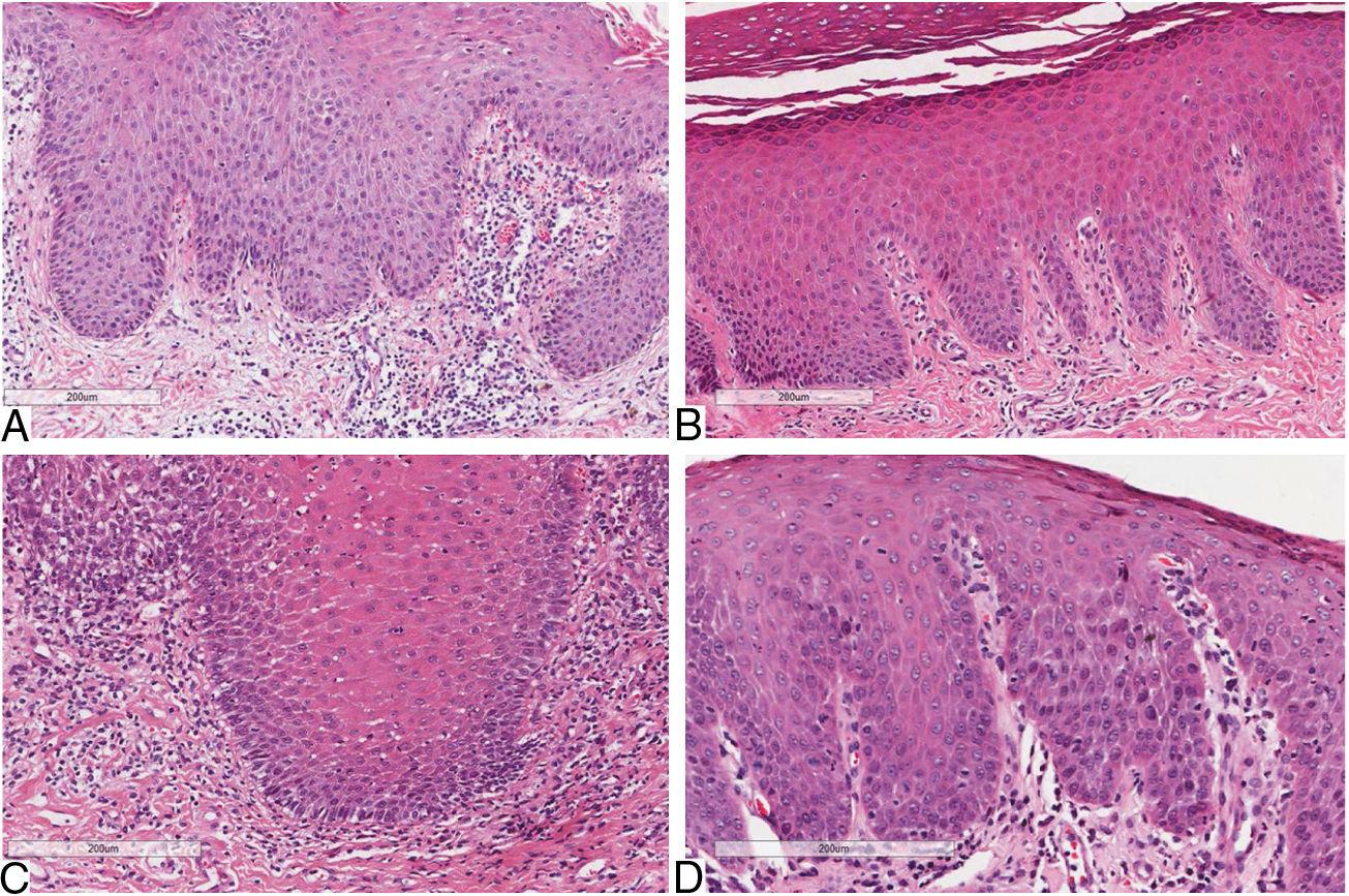 Evaluation of the Th17 pathway in psoriasis and geographic tongue ...