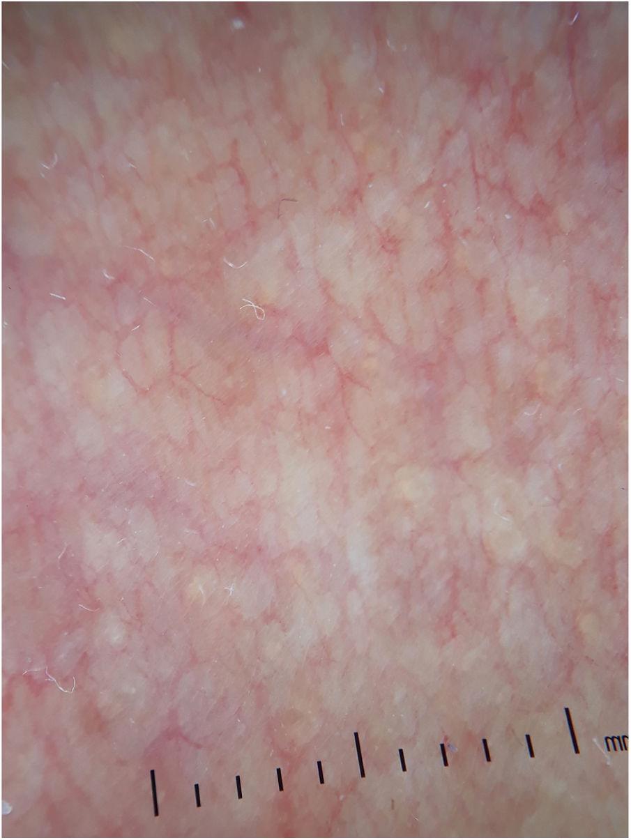 Pseudoxanthoma elasticum-like papillary dermal elastolysis in non ...