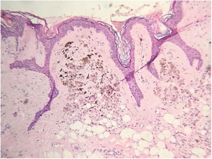 Intradermal Nevus Histology