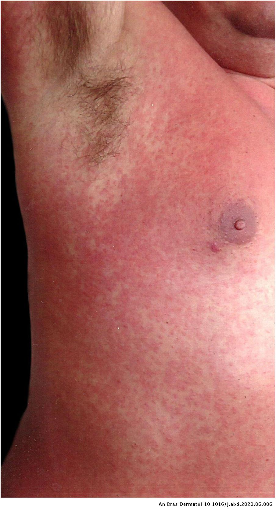 Exanthematic dengue fever mimicking rubella | Anais Brasileiros de ...