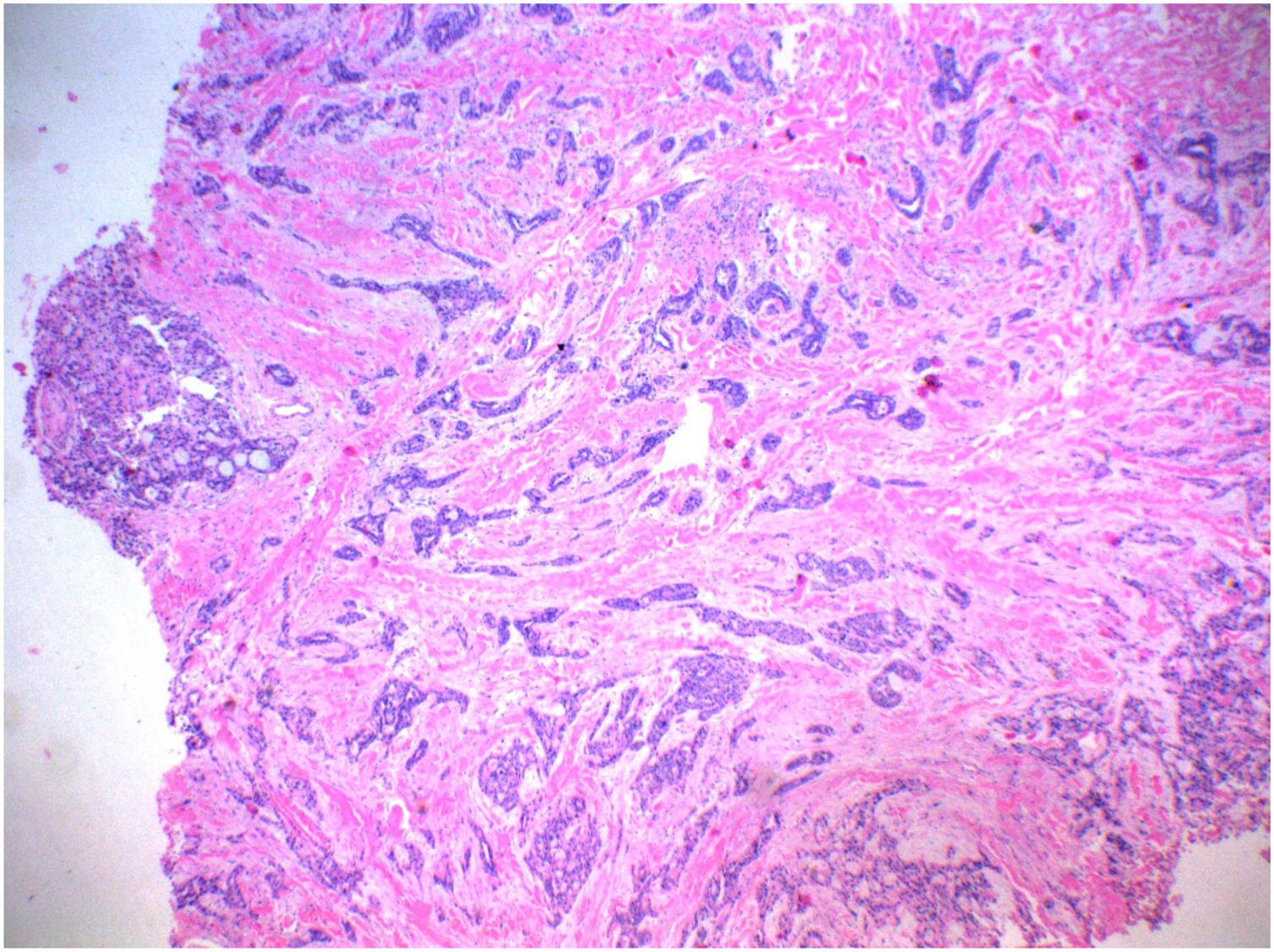 Hidradenocarcinoma | Anais Brasileiros de Dermatologia