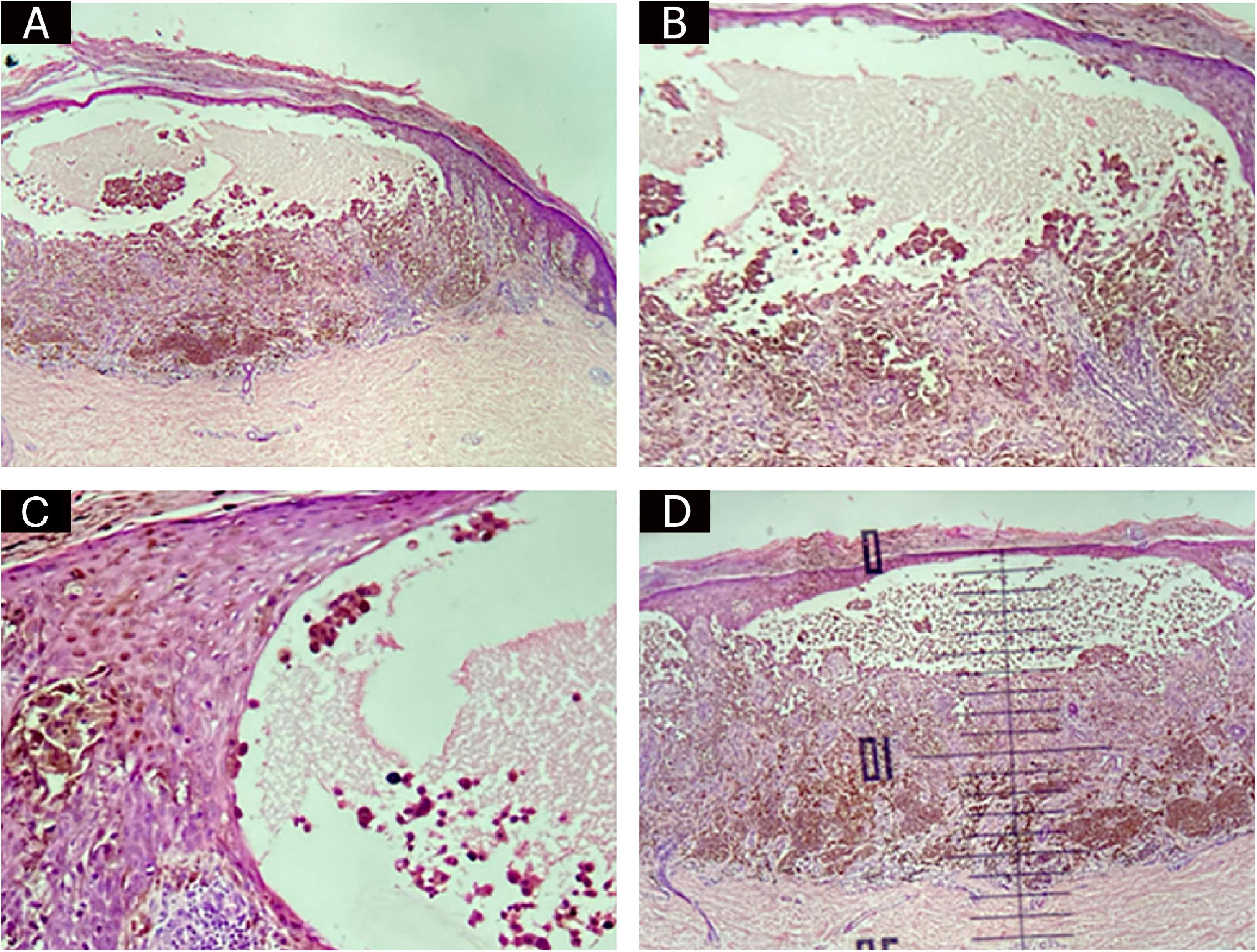 Bullous Melanoma: should the thickness of the bullous lesion be ...