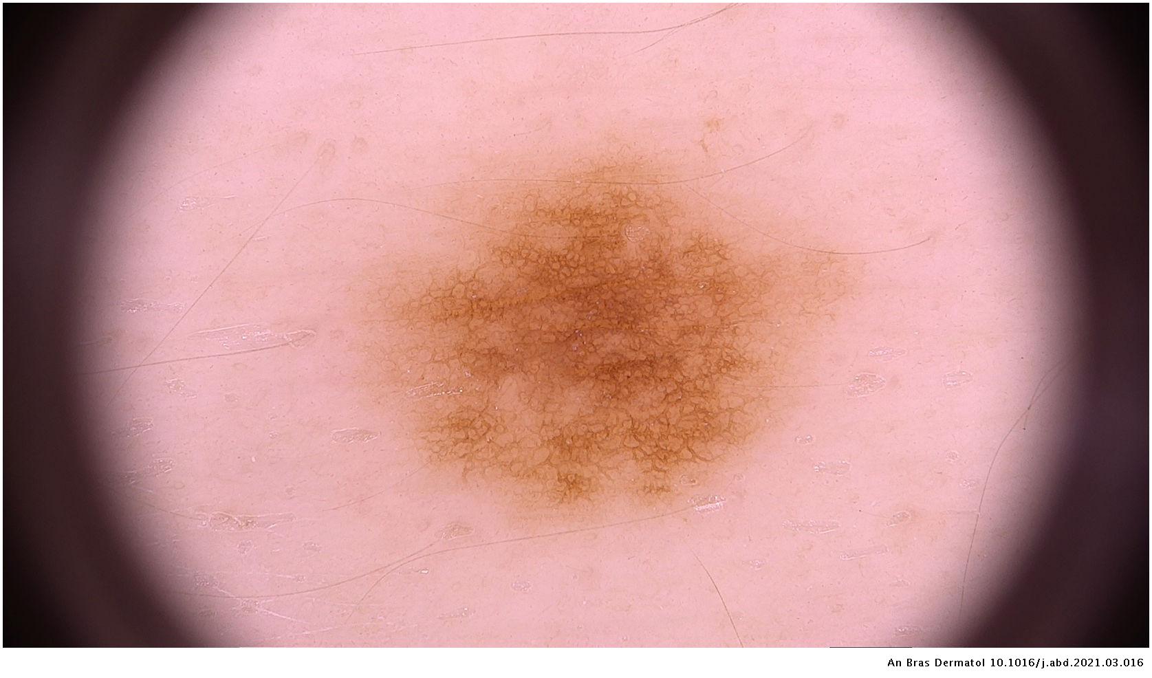 Dermoscopic characteristics of congenital melanocytic nevi in a cohort ...