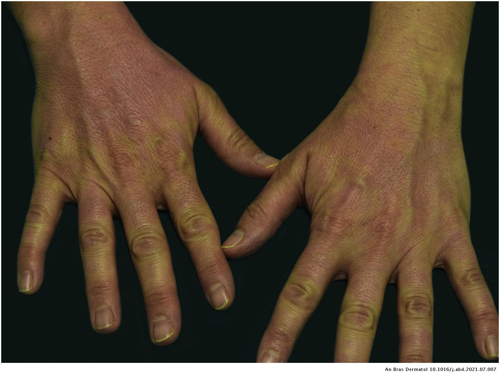 Photosensitive rash induced by nivolumab | Anais Brasileiros de ...