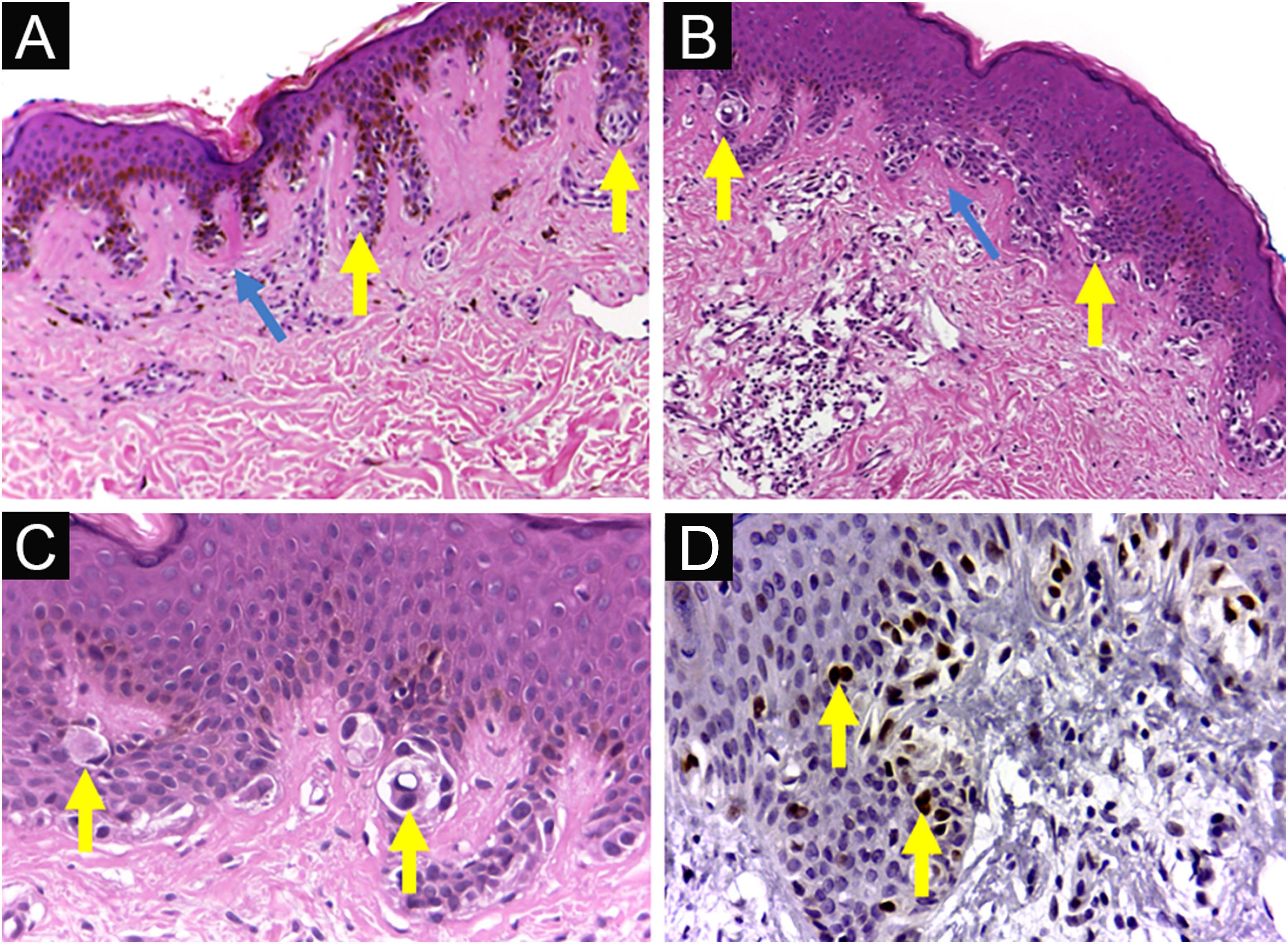 The texture of collagen and immunoexpression of PRAME in dysplastic ...