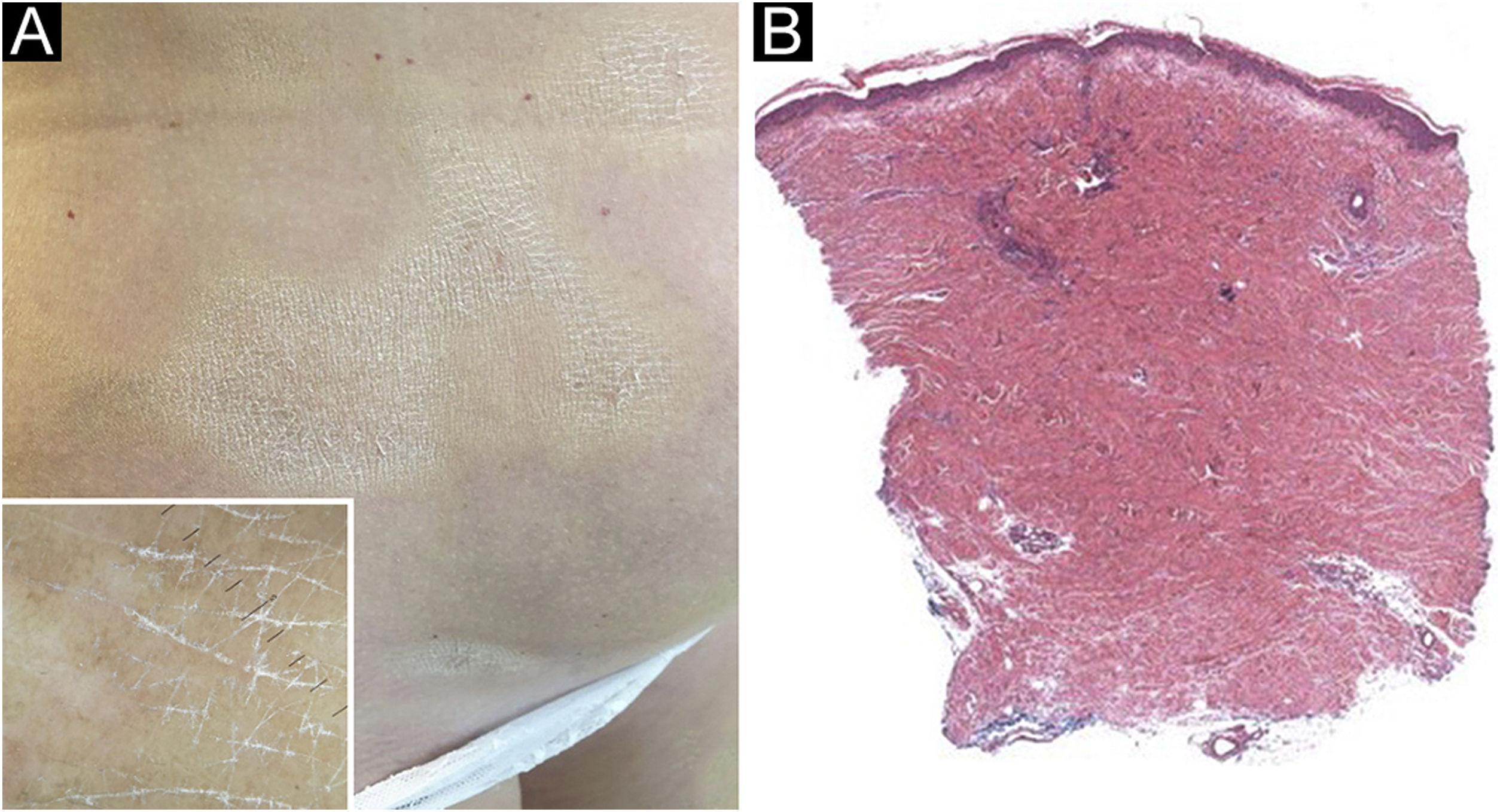 Morphea after SARS-CoV2 vaccine | Anais Brasileiros de Dermatologia