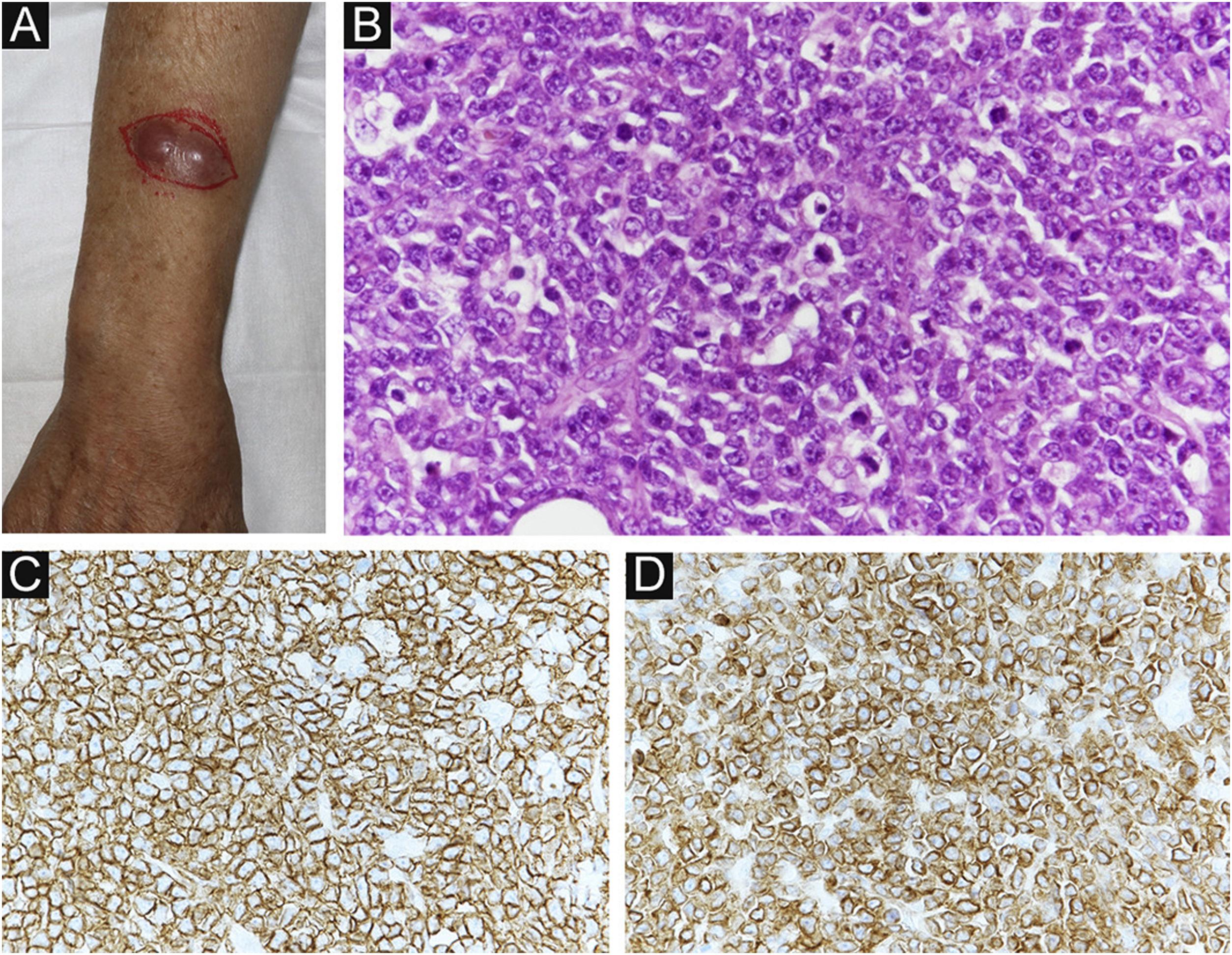 Invasive extramammary Paget's disease with lymph node metastases and