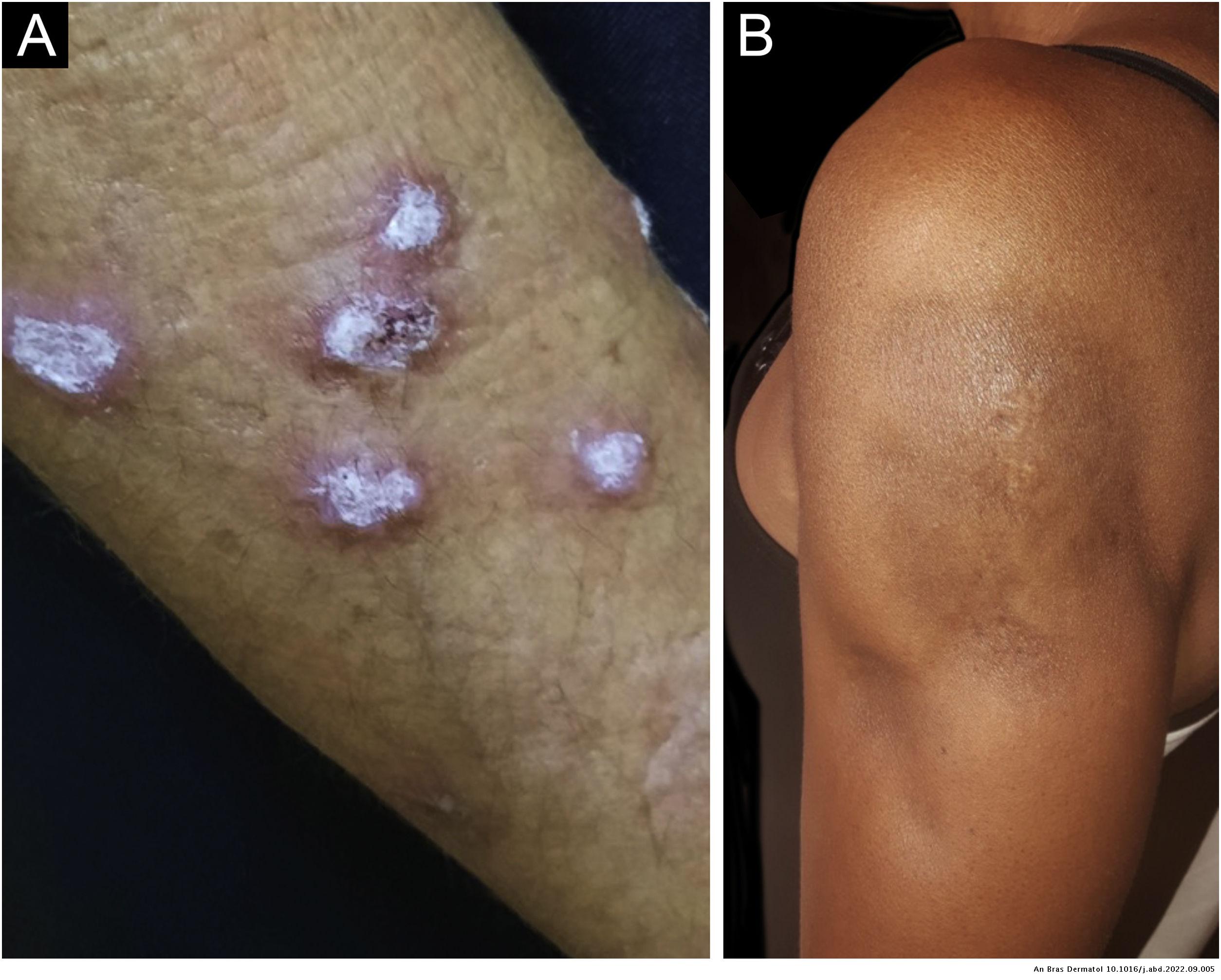 Lupus Rash On Upper Arms