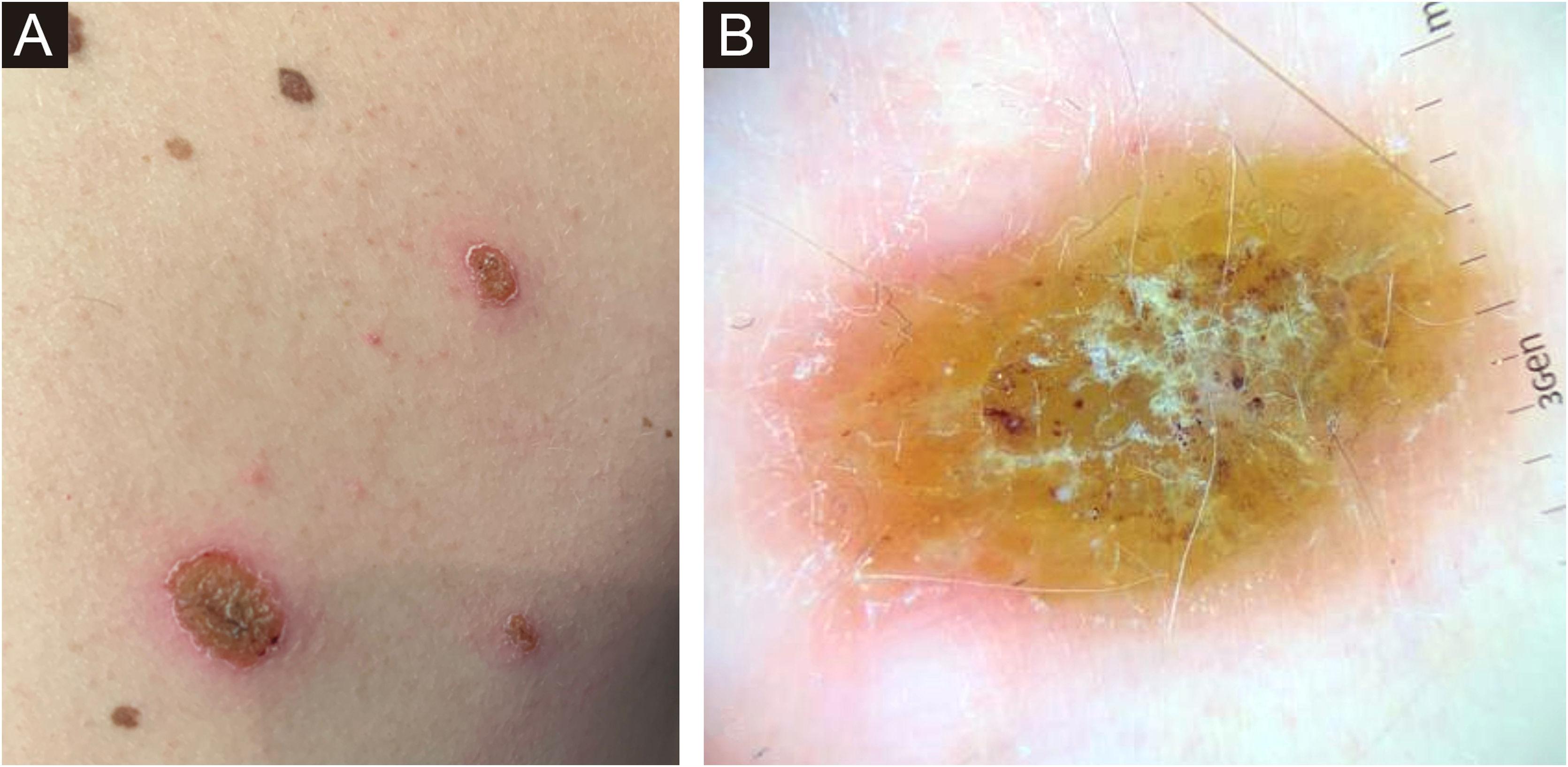 Meyerson nevus triggered by COVID-19 | Anais Brasileiros de ...