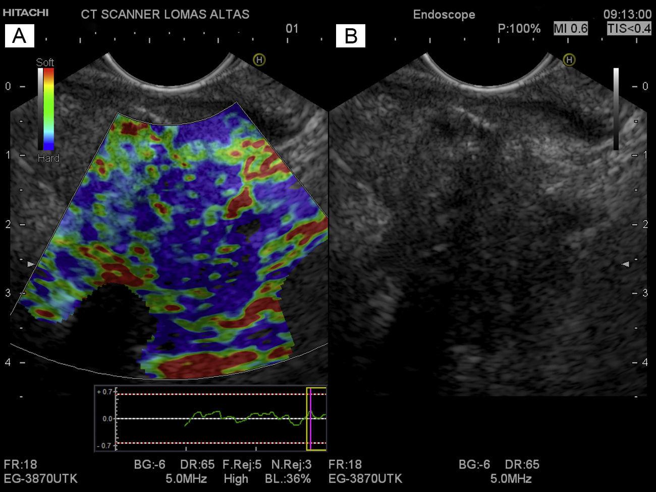 Utilidad Del Ultrasonido Endoscópico Con Elastografía En La Evaluación ...