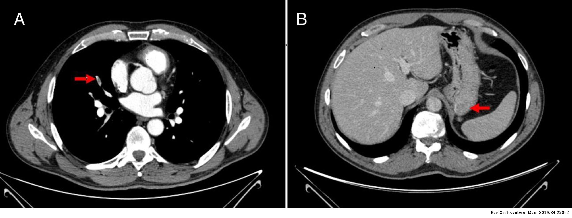 Tumor del estroma gastrointestinal como causa de trombosis asociada a