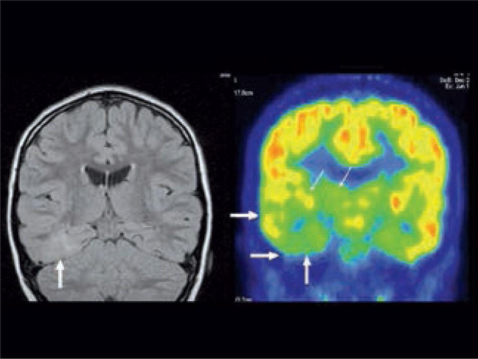 Rol del PET/CT en epilepsia | Revista Médica Clínica Las Condes
