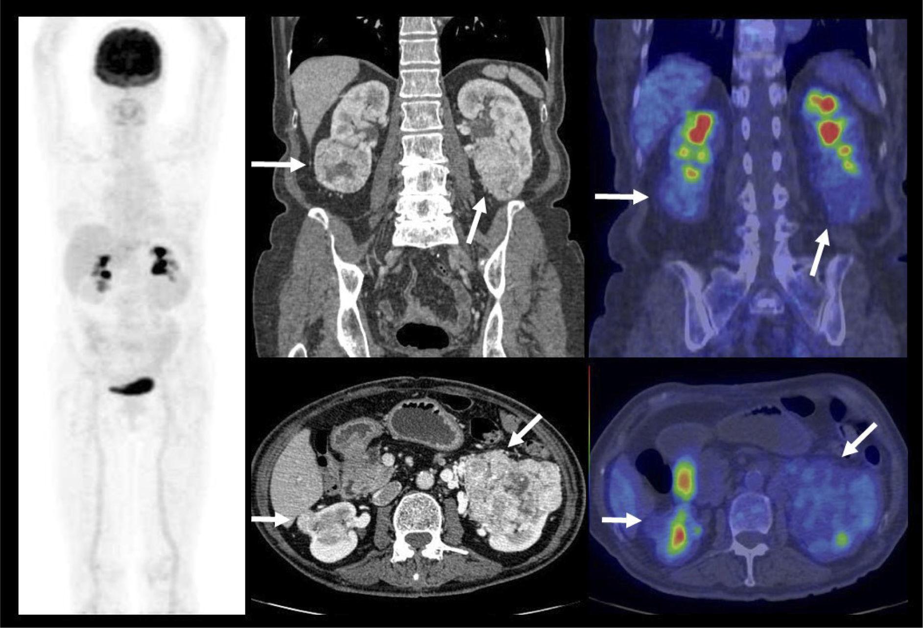 PET/CT en Urología Oncológica: Puesta al día | Revista Médica Clínica ...