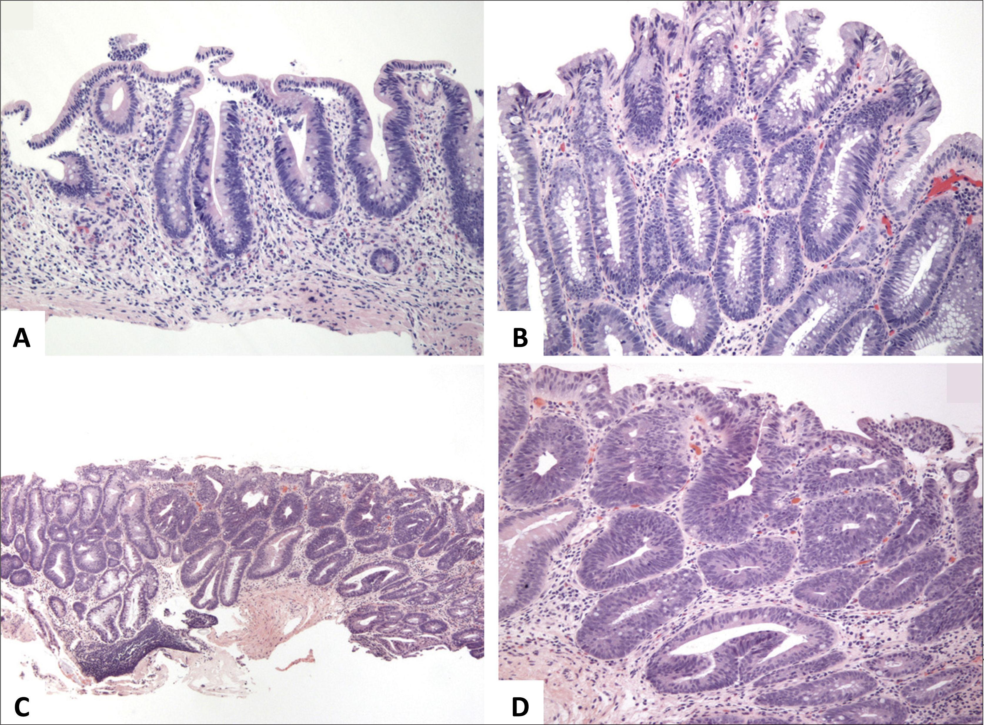 Histología En La Enfermedad Inflamatoria Intestinal | Revista Médica ...