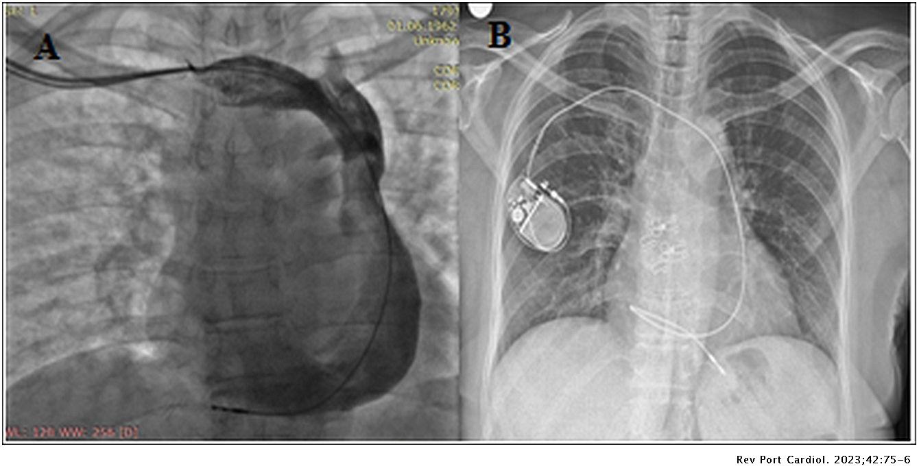 Placement of permanent pacemaker in a patient with venous anomaly ...