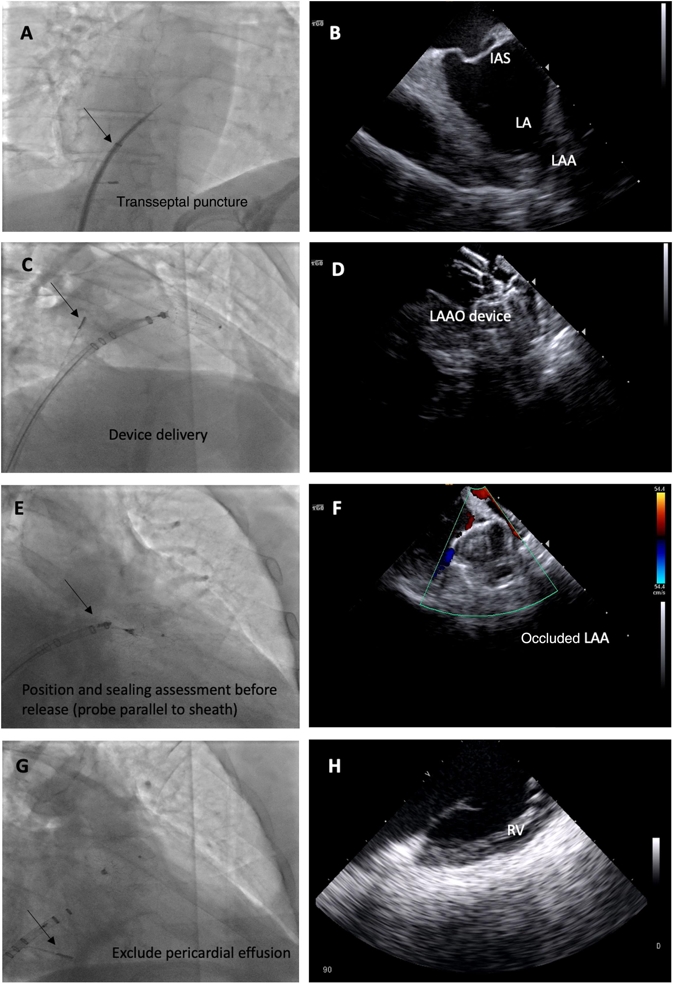 Intracardiac Echocardiography Guided Left Atrial Appendage Occlusion The Path To Independence