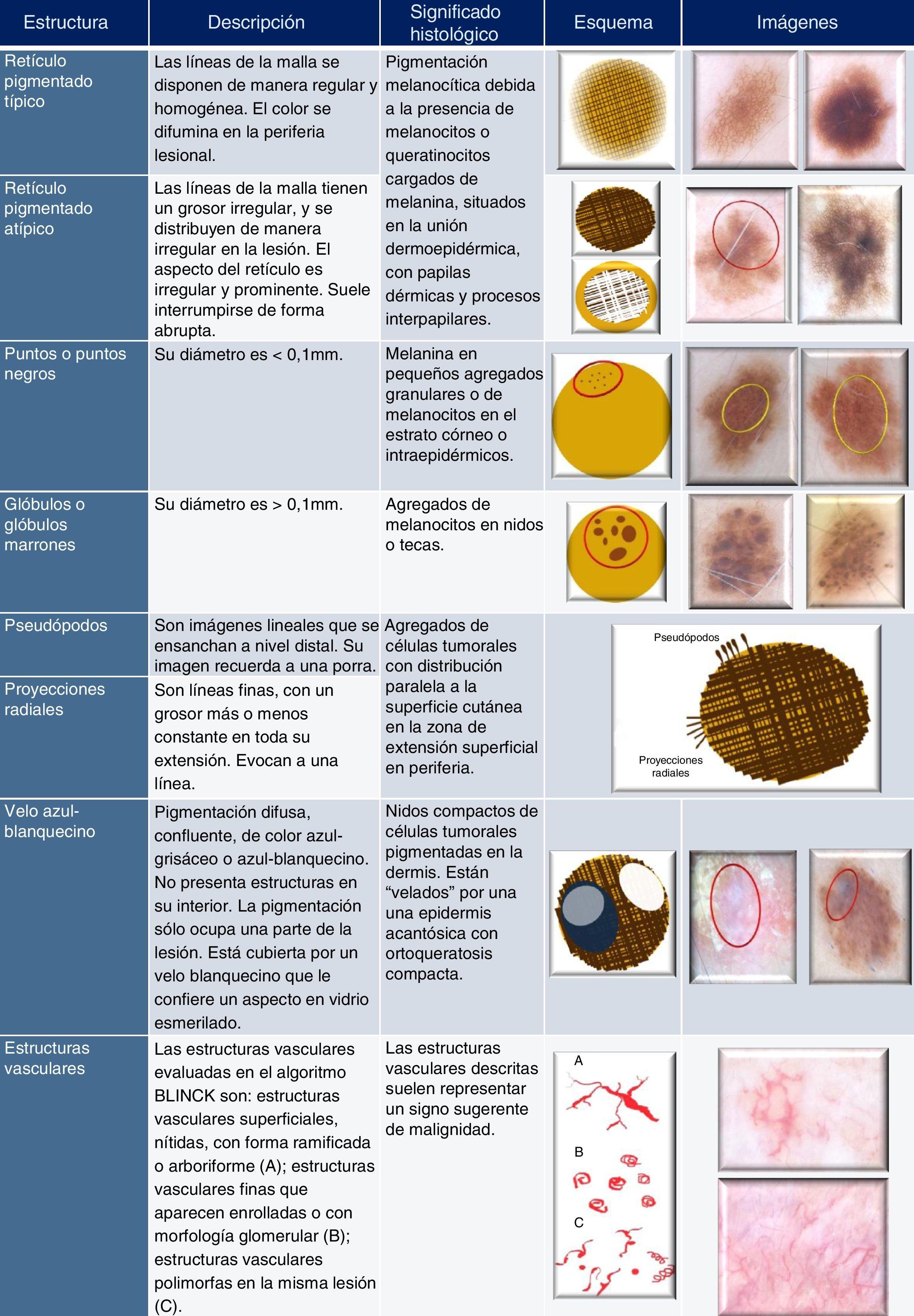 Dermatoscopia Para Principiantes Ii Estructuras Dermatoscópicas Y Métodos Diagnósticos 1505