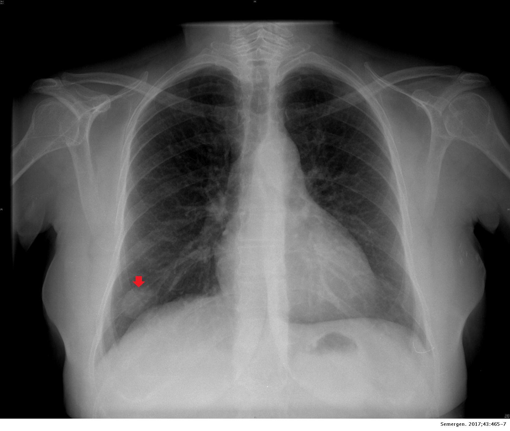 Hamartoma pulmonar como presentación de un nódulo pulmonar solitario Medicina de Familia. SEMERGEN Hamartoma pulmonar como presentación de un nódulo pulmonar solitario Medicina de Familia. SEMERGEN