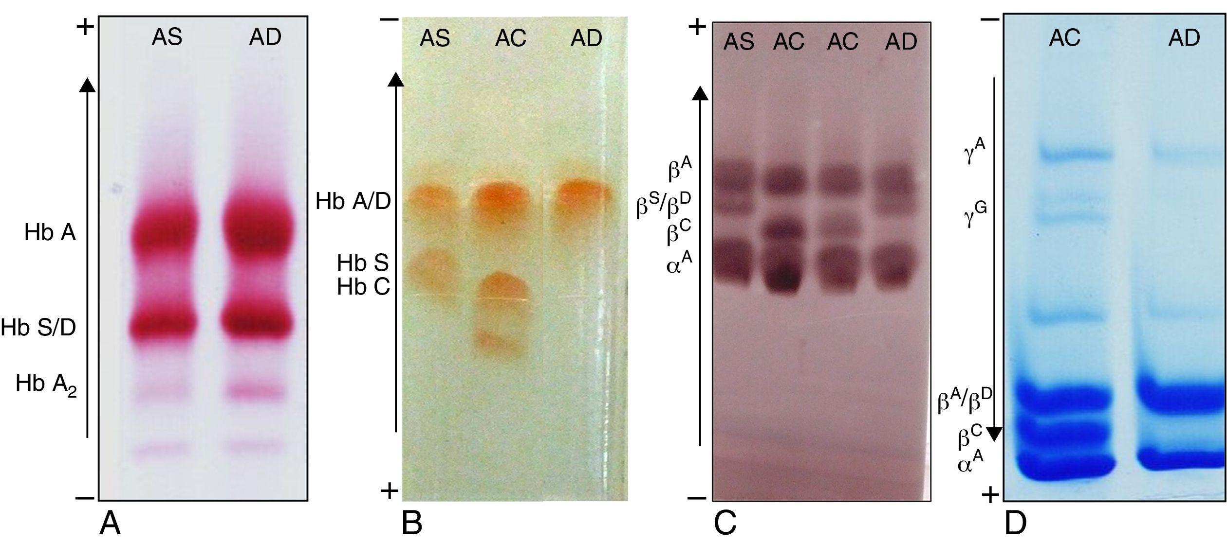 Hemoglobin Electrophoresis Cellulose Acetate