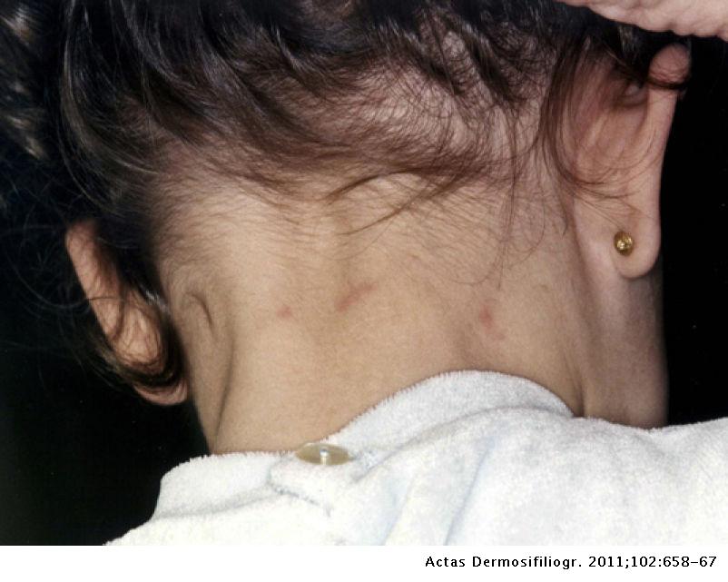 Skin Reactions on Exposure to the Pine Processionary Caterpillar ...