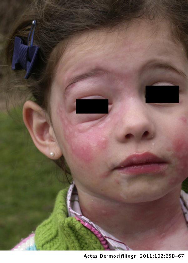 Skin Reactions on Exposure to the Pine Processionary Caterpillar ...