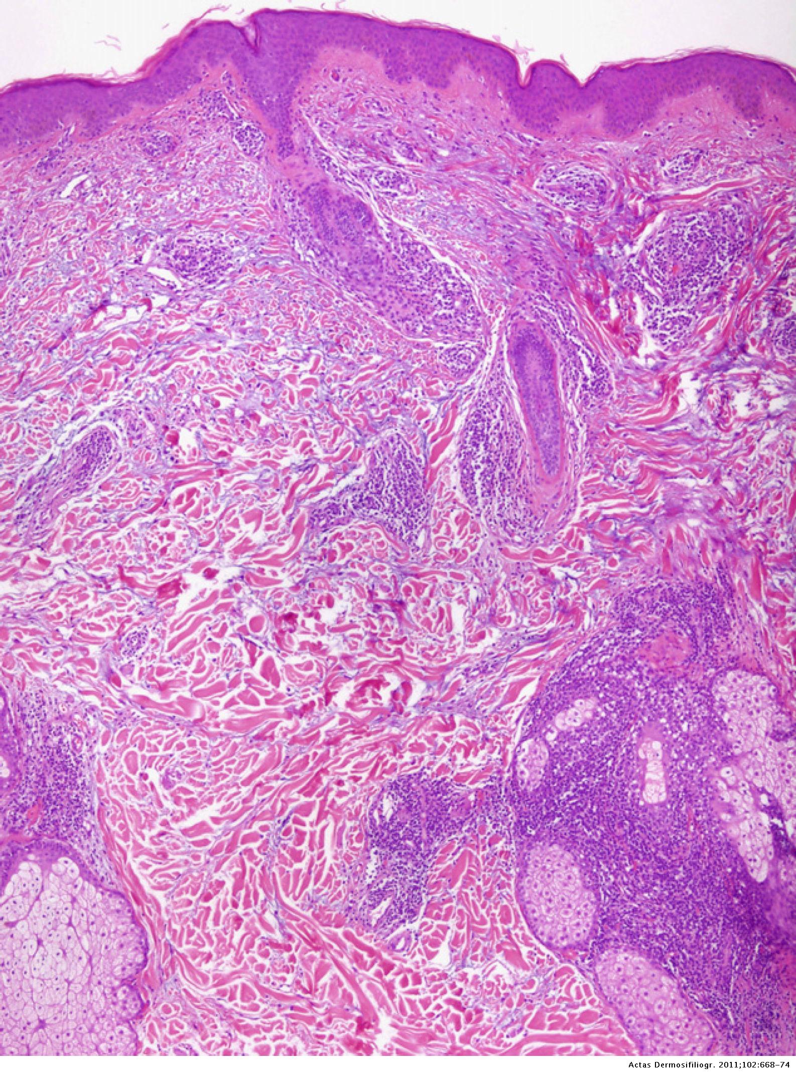 Polymorphous Light Eruption Histology