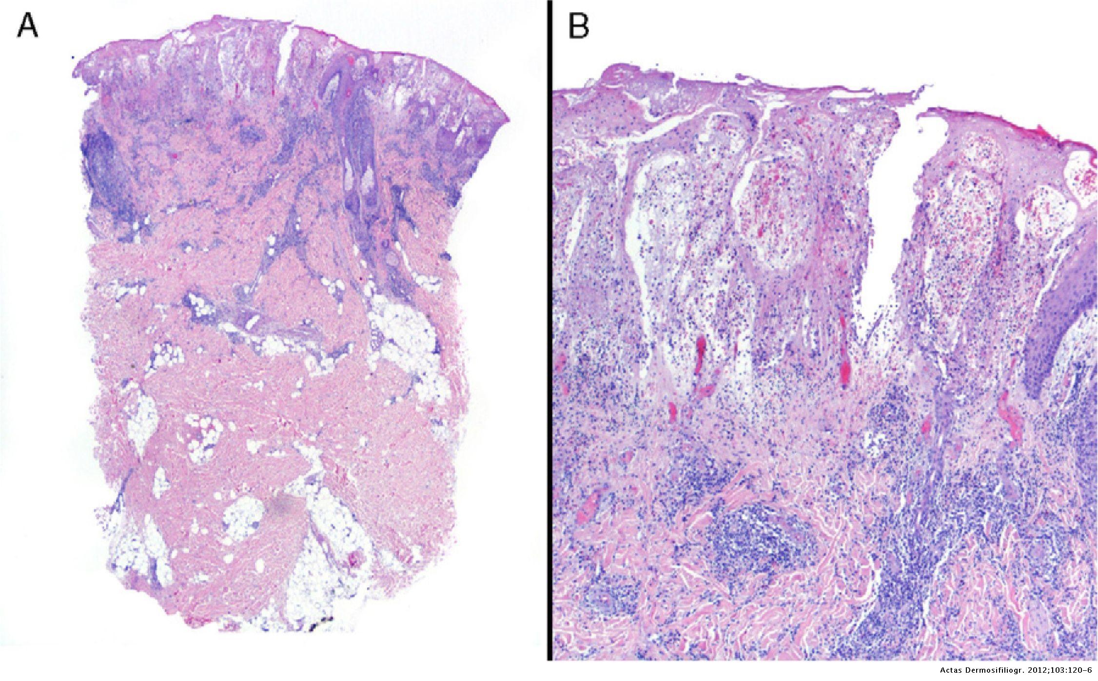 Pyoderma Gangrenosum Histology