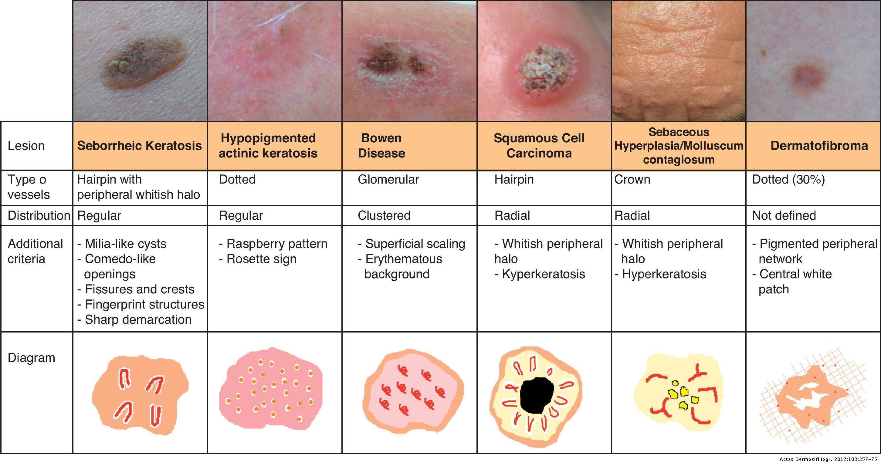 Vascular Patterns in Dermoscopy Actas DermoSifiliográficas
