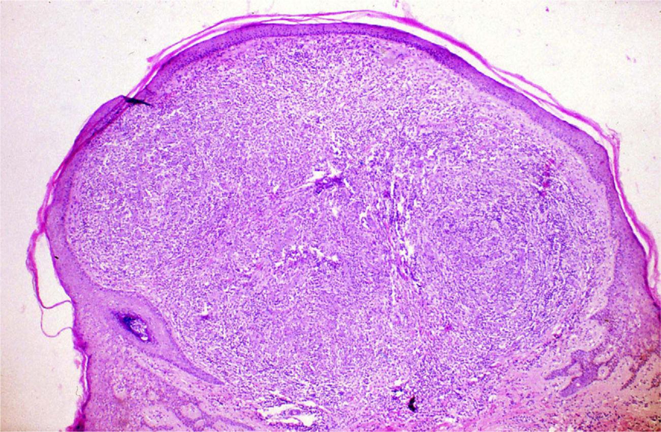 Oral Pyogenic Granuloma Histology