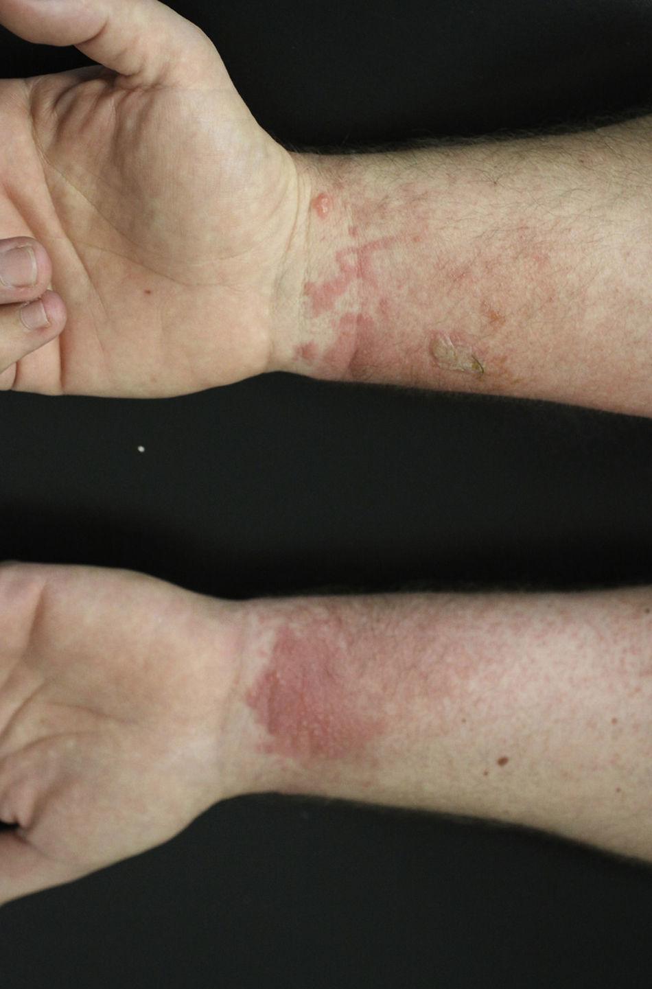 Allergic Contact Dermatitis to Plants Understanding the Chemistry will