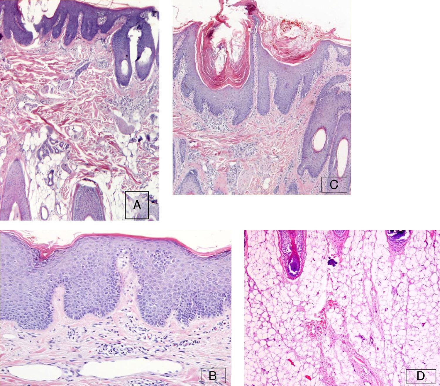 Lipedematous Alopecia in a Patient With Scalp Psoriasis Actas Dermo