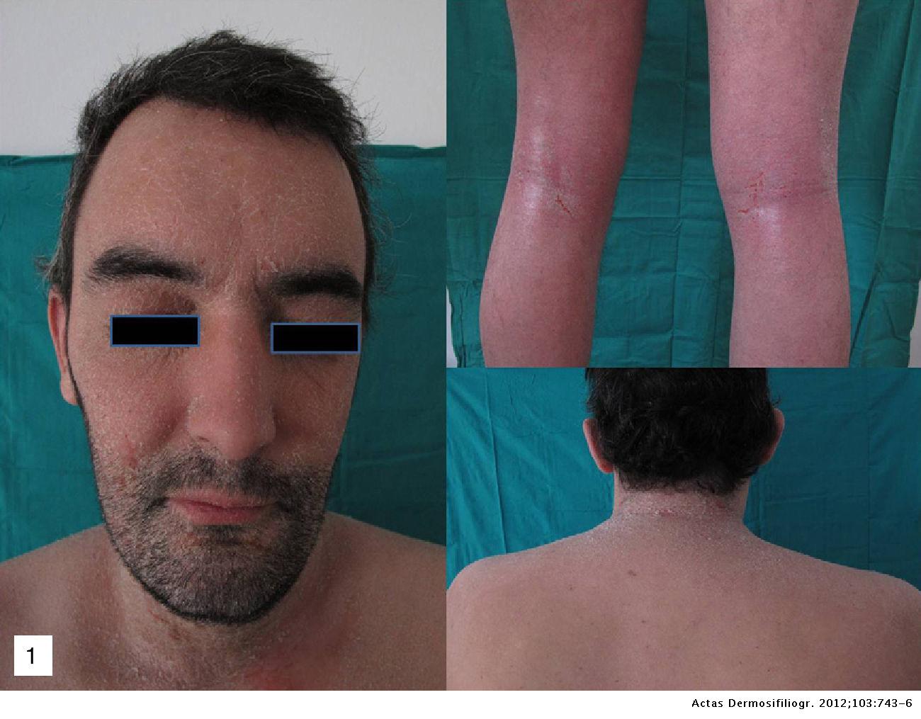 Exacerbation of Atopic Dermatitis in a Patient Treated With Infliximab ...