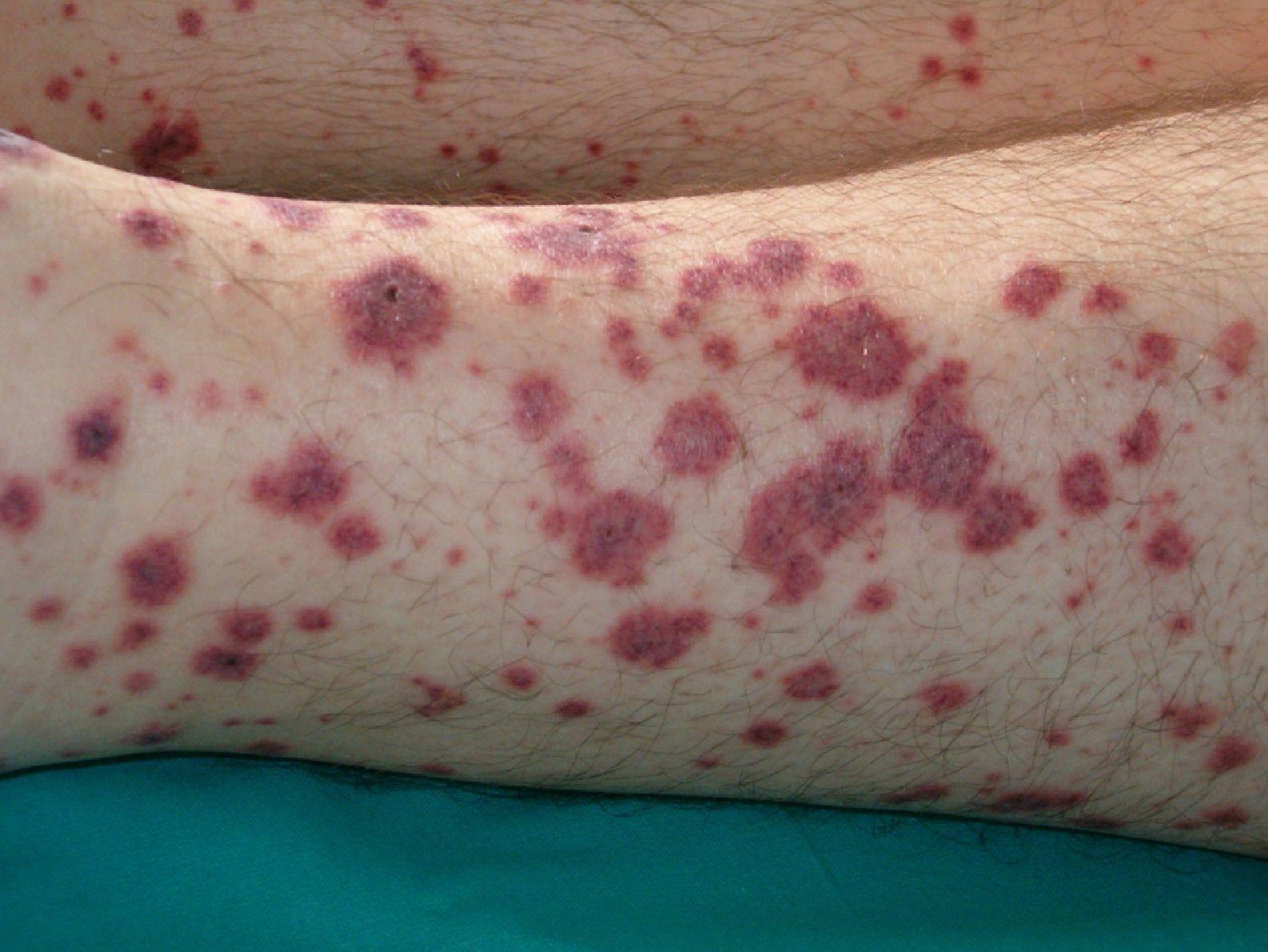 Cutaneous Alerts in Systemic Malignancy Part I Actas Dermo