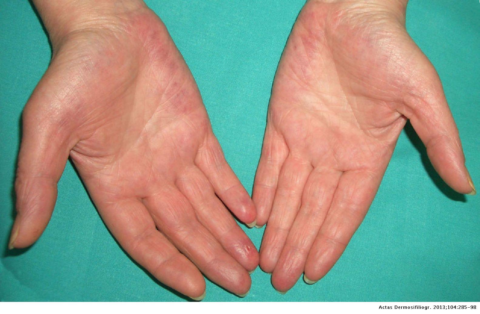 Cutaneous Alerts in Systemic Malignancy: Part I | Actas Dermo ...