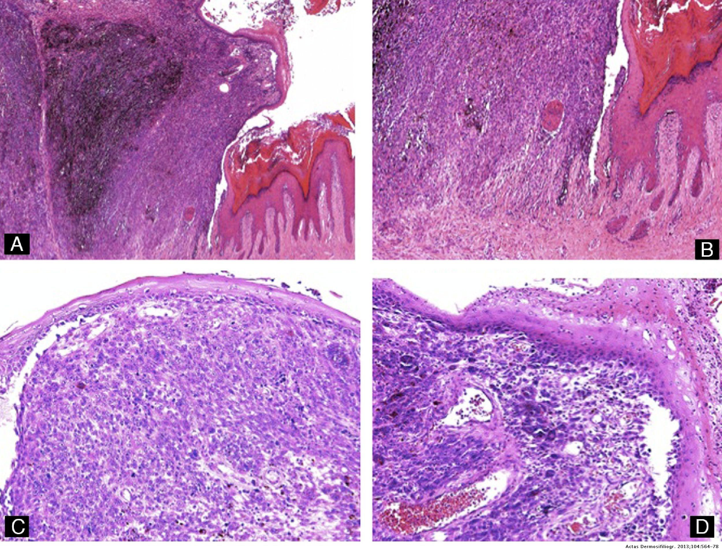 Nail Histopathology | Actas Dermo-Sifiliográficas