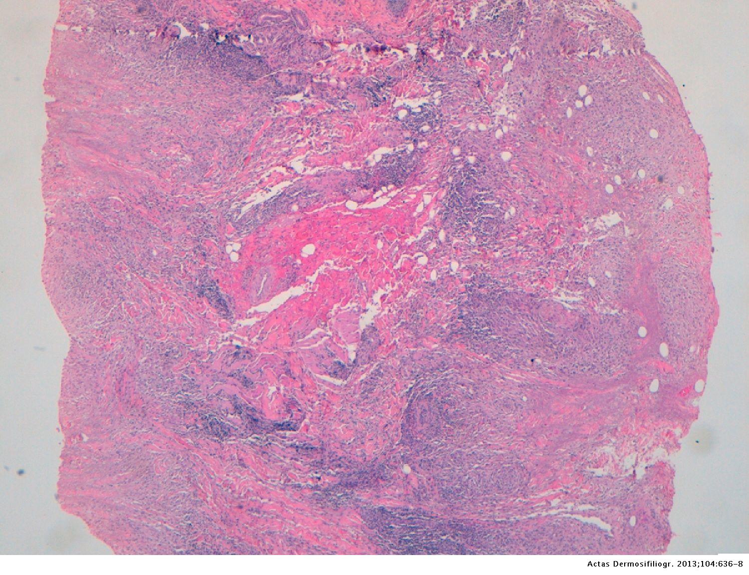 Necrobiosis Lipoidica Diabeticorum Histology