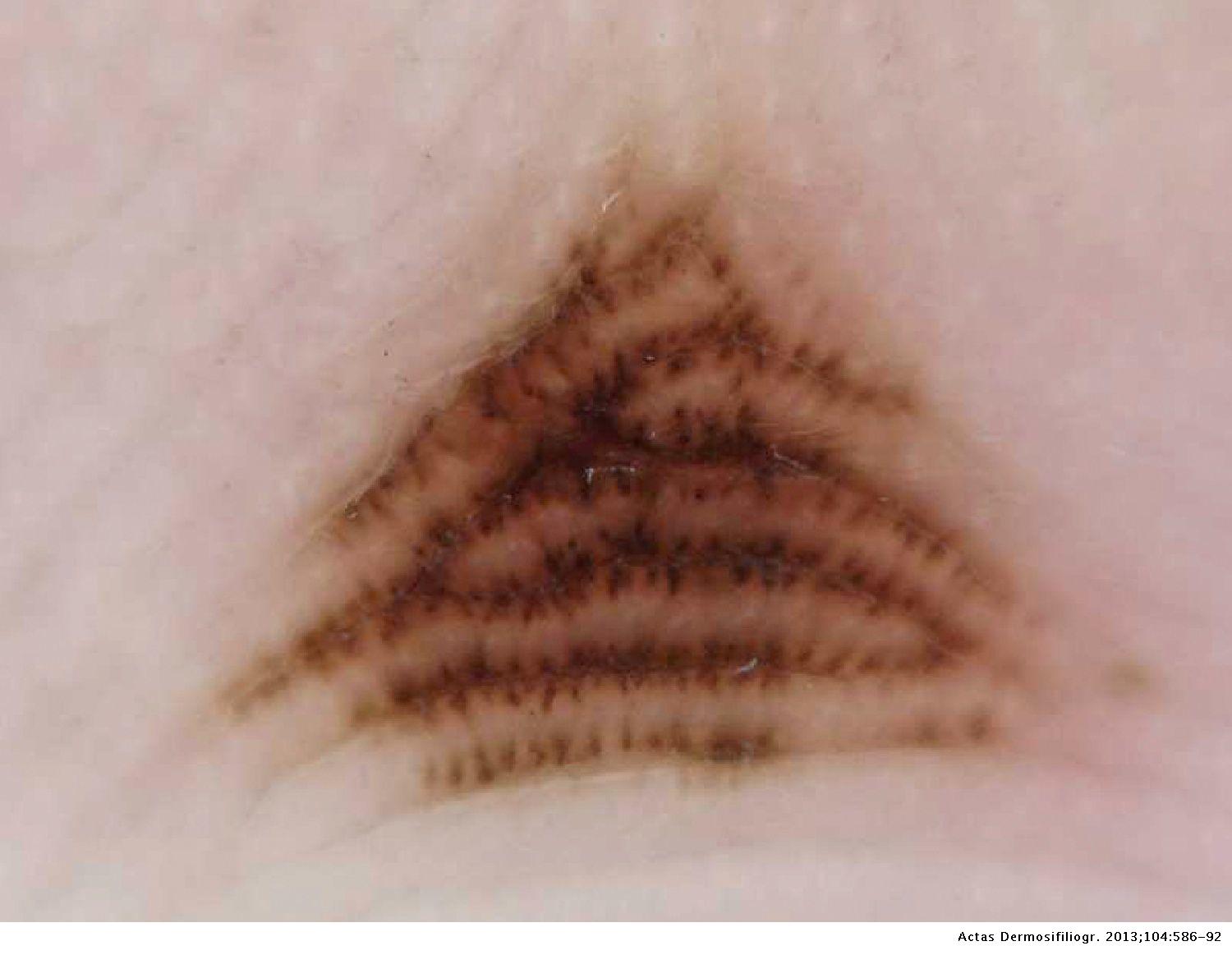 Dermoscopic Patterns of 158 Acral Melanocytic Nevi in a Latin American