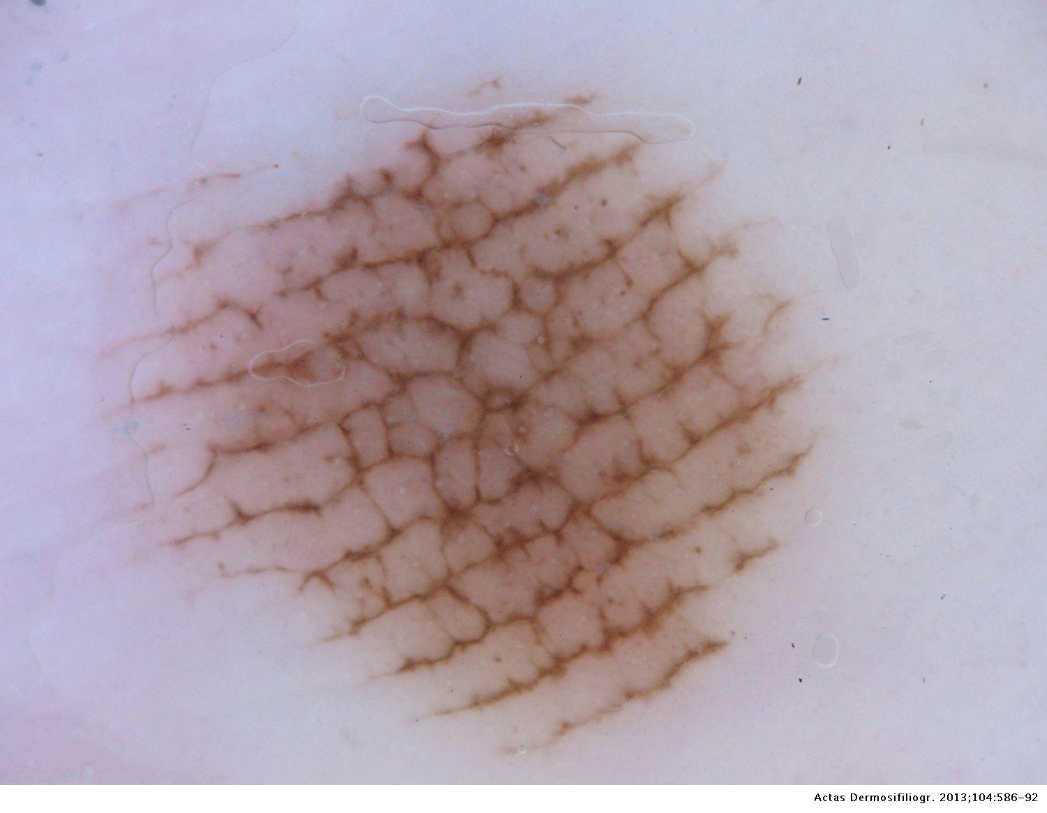 Melanocytic Nevus Palm