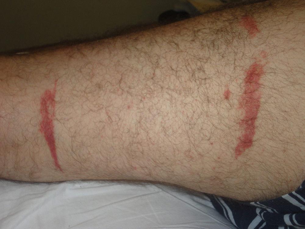 Acute Skin Lesions After Surgical Procedures A Clinical Approach