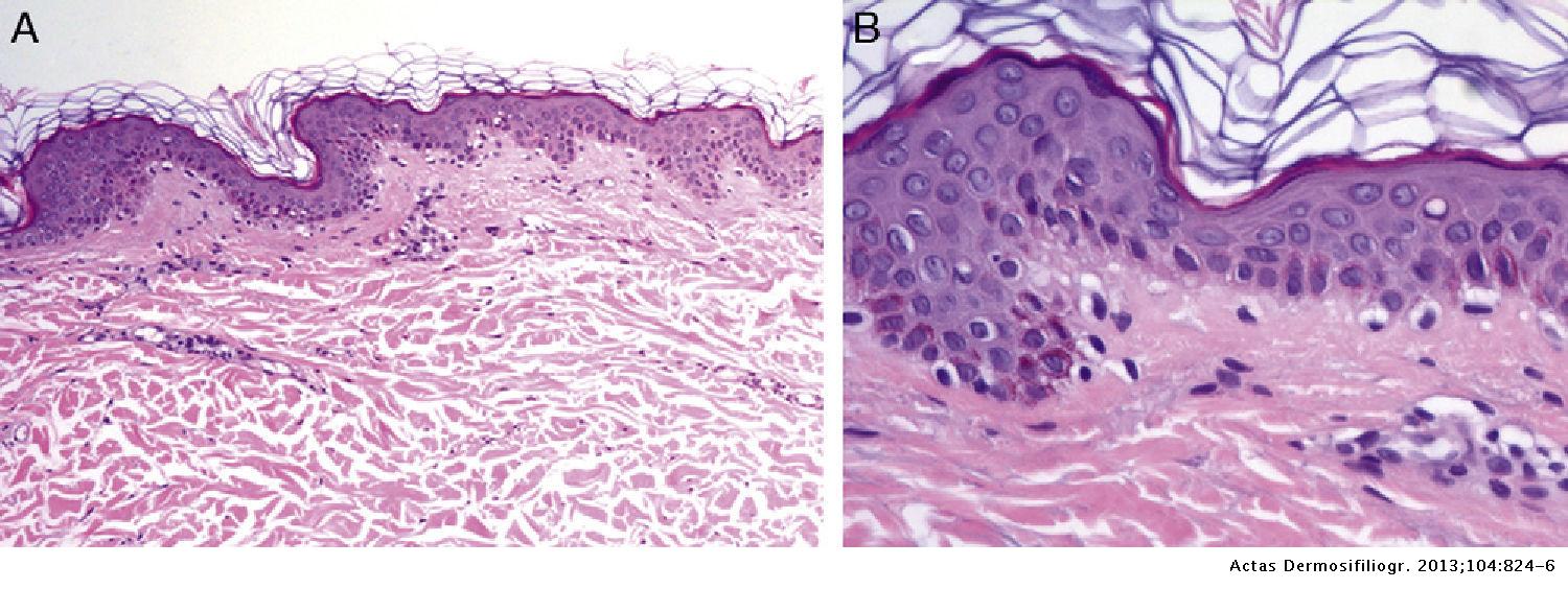 Progressive Cribriform and Zosteriform Hyperpigmentation | Actas Dermo ...