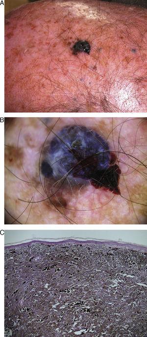 Animaltype Melanoma Clinical and Dermoscopic Features of 3 Cases