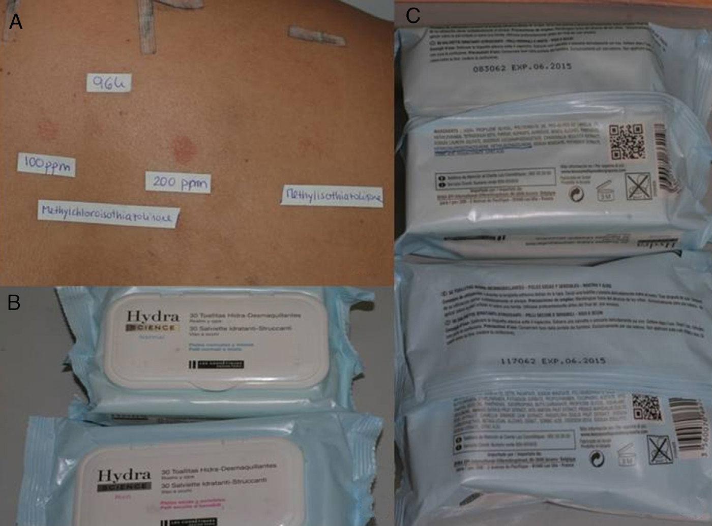 Update on Allergic Contact Dermatitis Due to