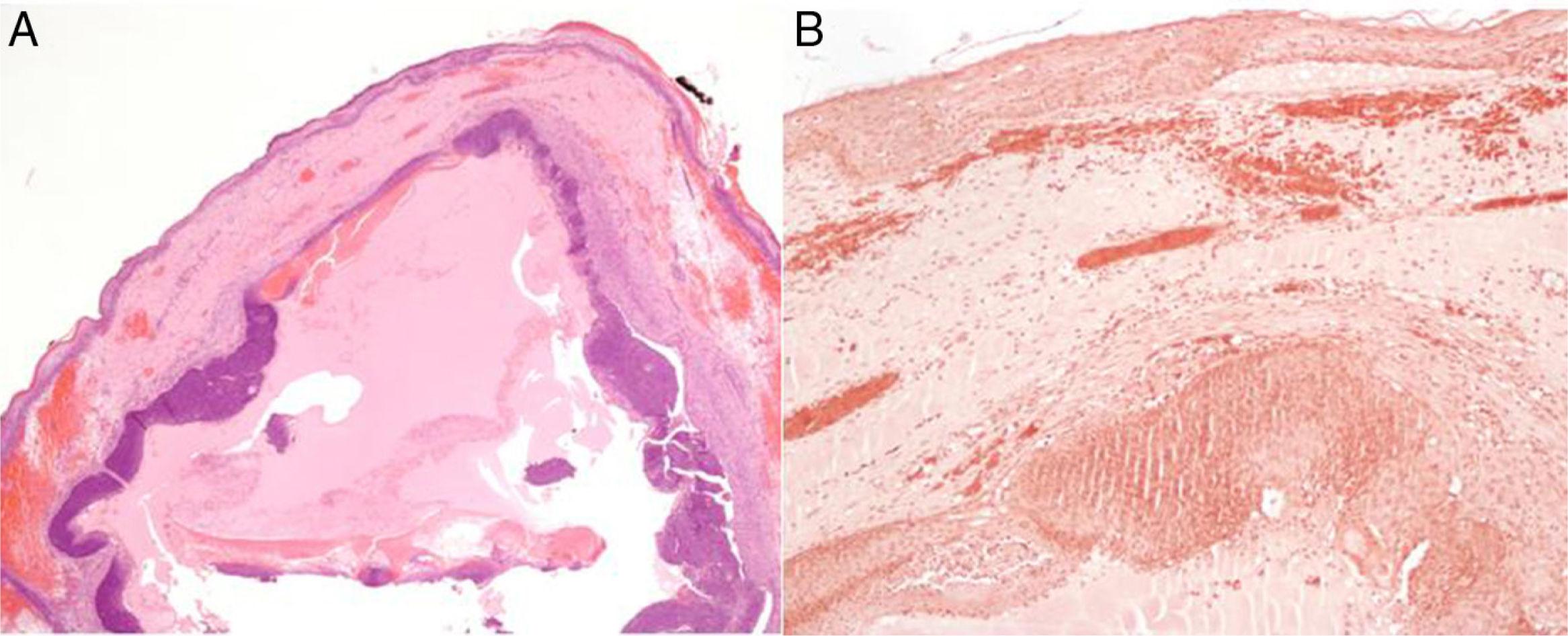A Tumor In Images Anetodermic Pilomatrixoma Actas Dermo Sifiliográficas