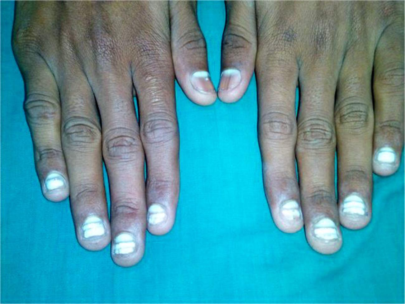 Discover more than 125 calcium deficiency nails treatment best ...