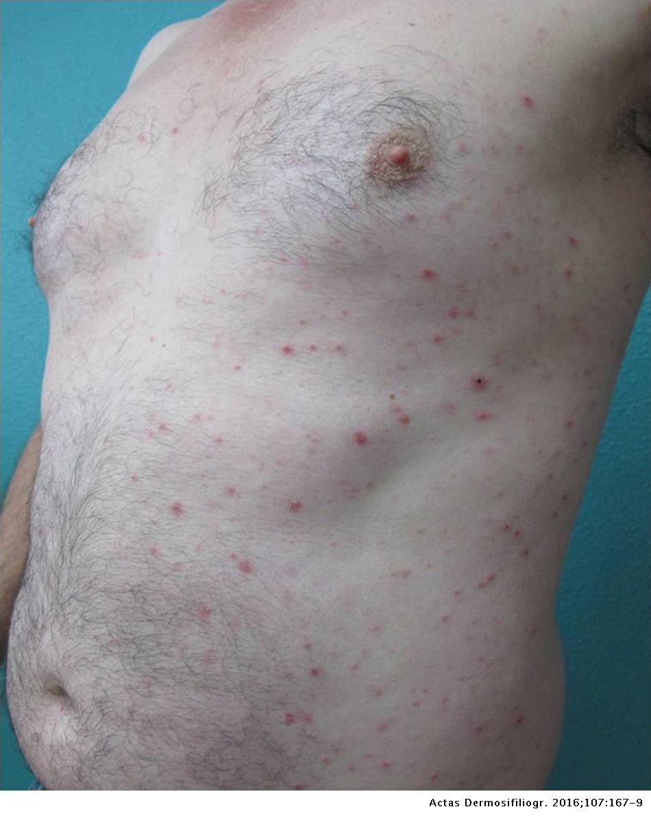 Humira Side Effects Rash