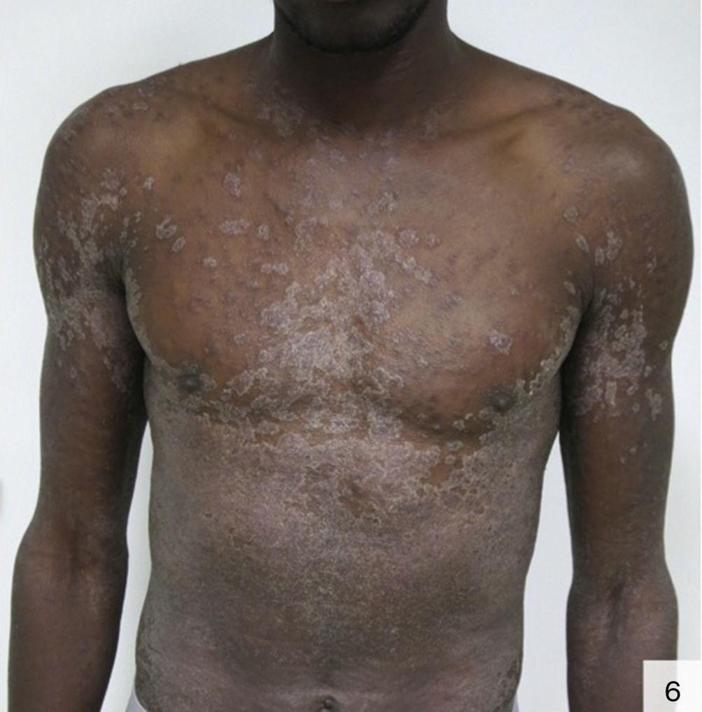 Atypical Cutaneous Manifestations in Syphilis | Actas Dermo-Sifiliográficas