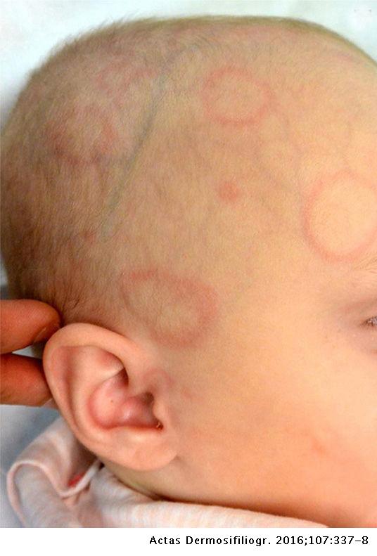 Granuloma Annulare Face